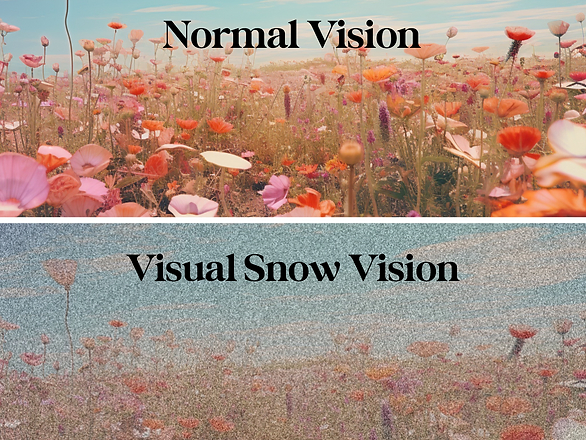 does visual snow get worse - visual snow comparison 